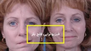 فلج بلز