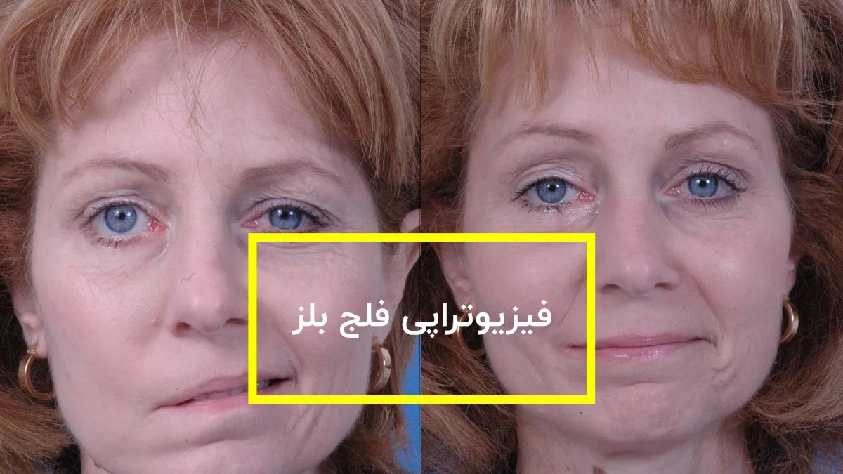 فلج بلز