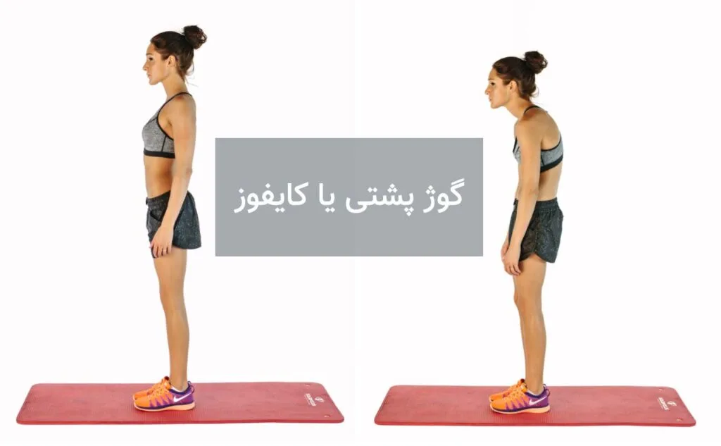 درمان قوز کمر با فیزیوتراپی