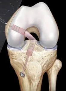 درمان رباط صلیبی خلفیPCL زانو 