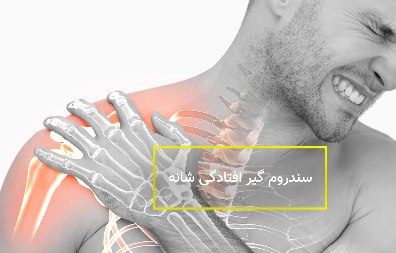 سندرم گیر افتادگی شانه
