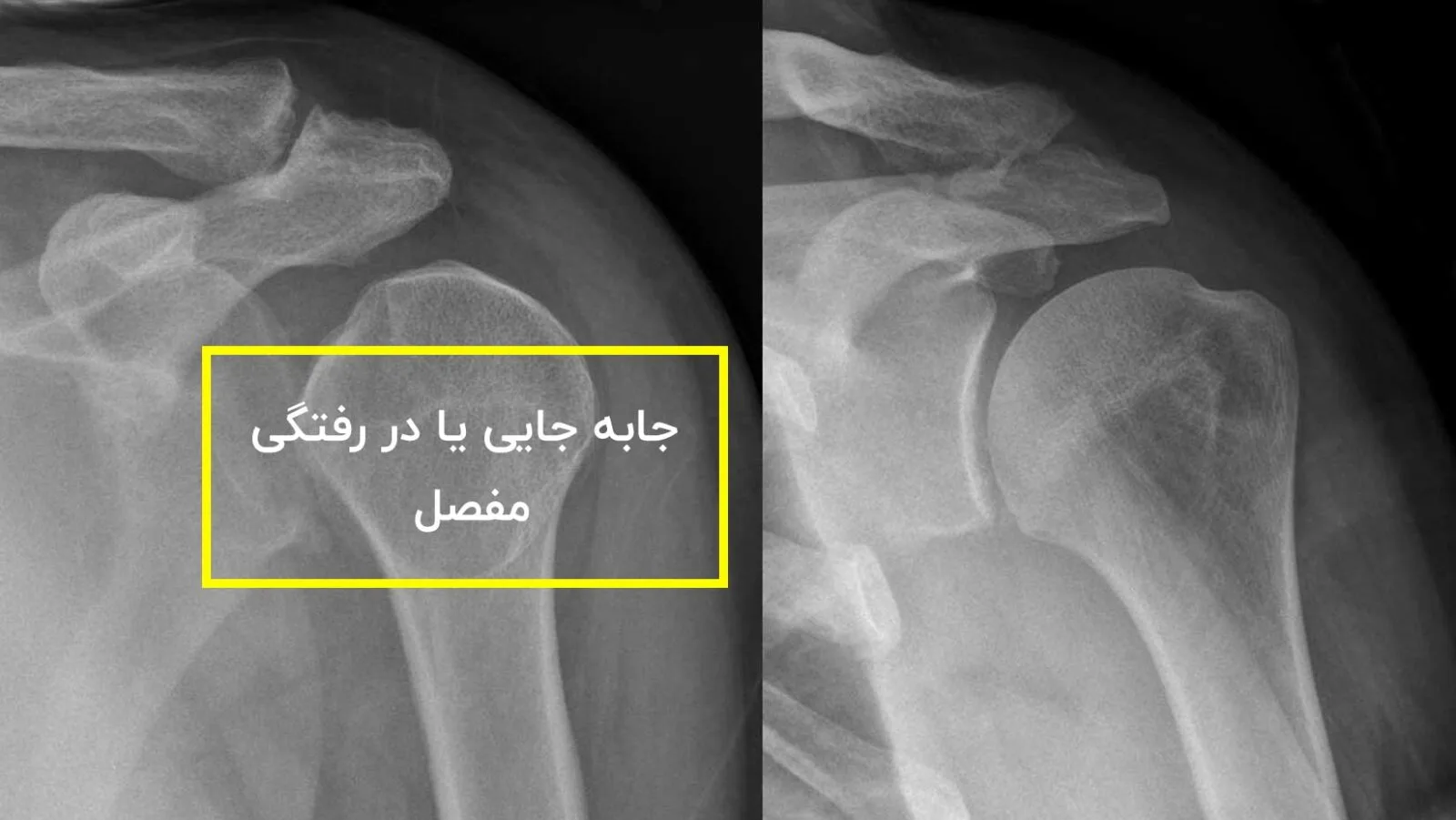 جا به جایی یا در رفتگی شانه