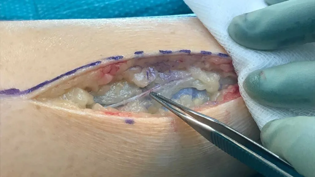 عوارض سندروم کمپارتمان