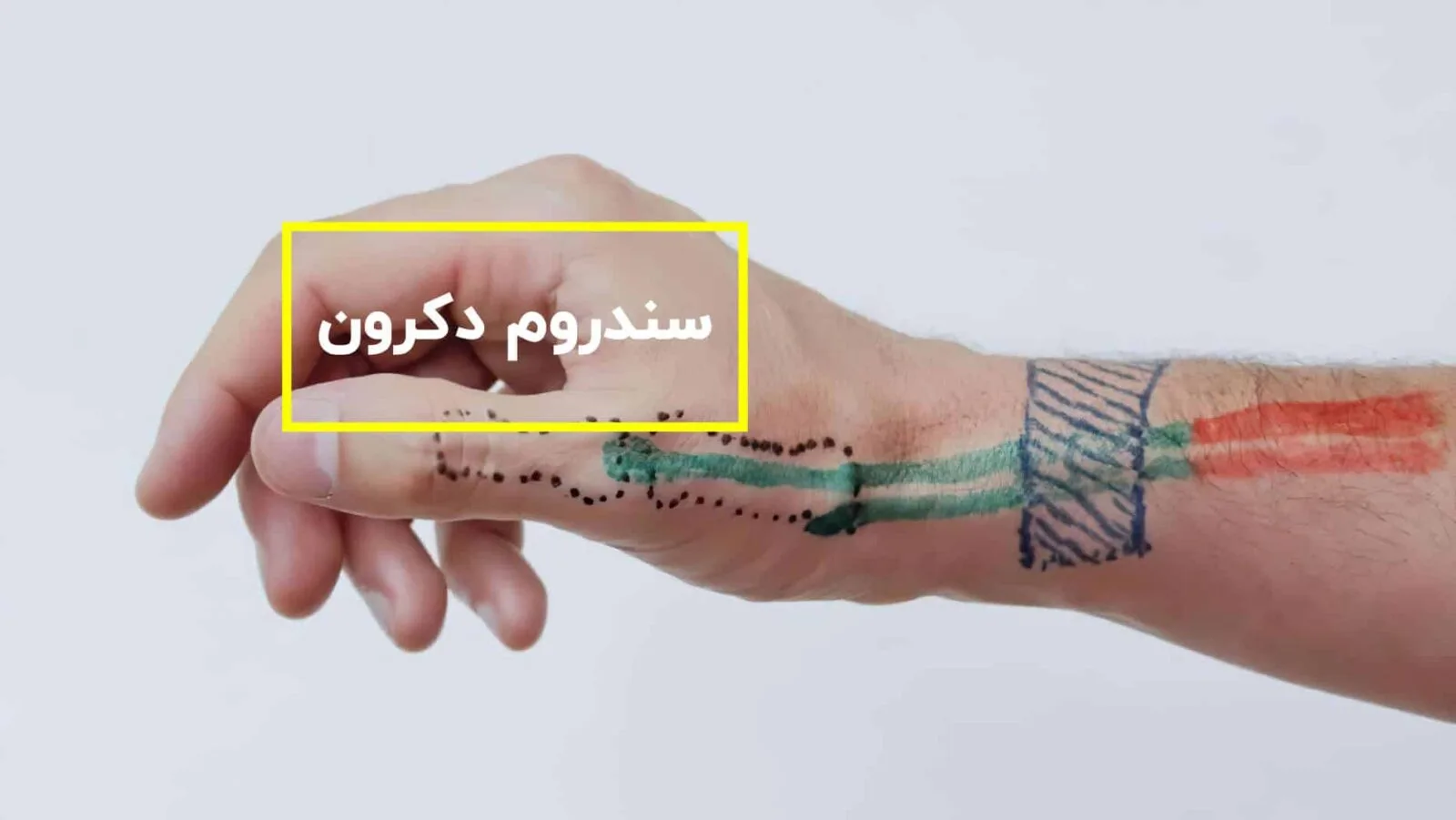 سندروم دکرون