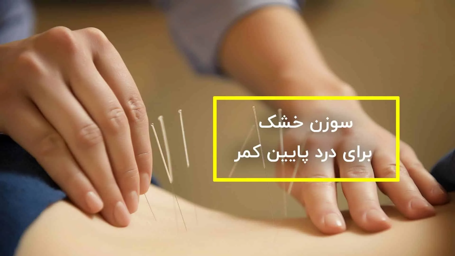 سوزن خشک برای درد پایین کمر