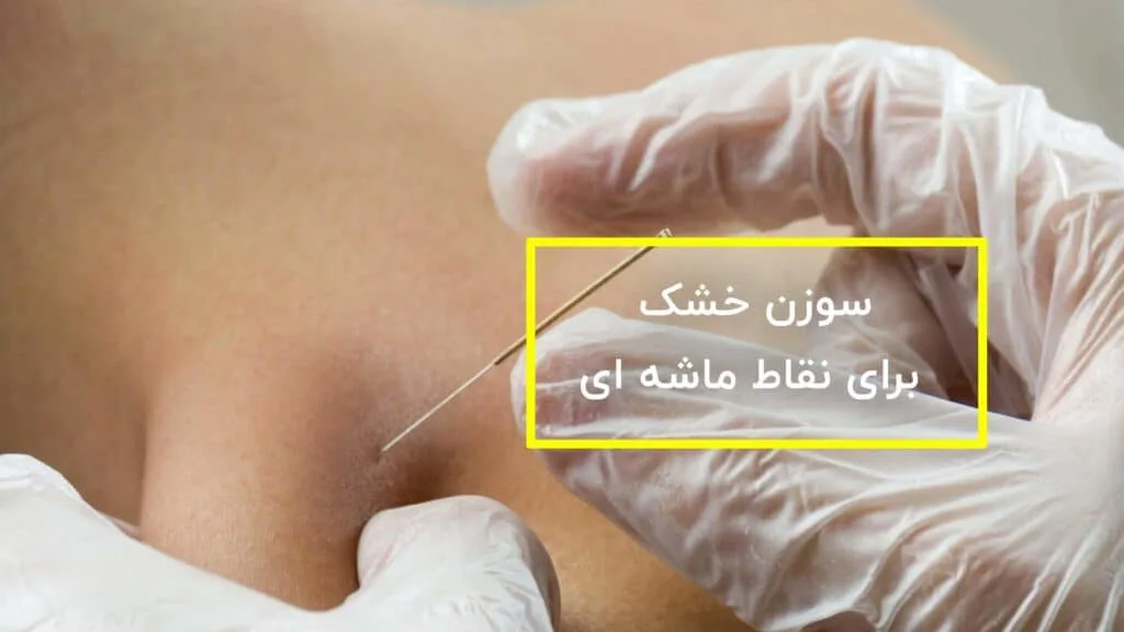 سوزن خشک برای نقاط ماشه ای