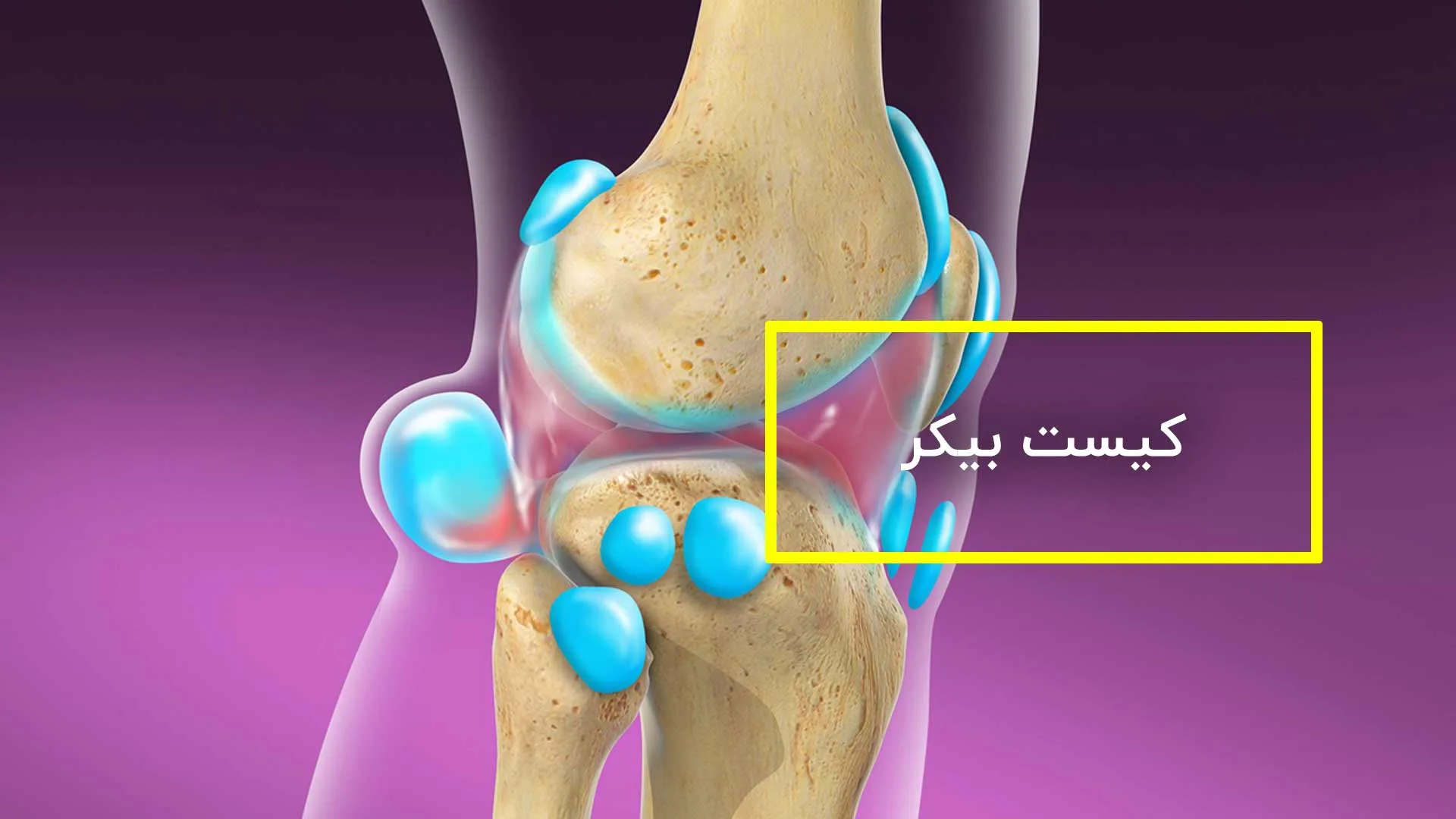 کیست بیکر چیست ، علائم ، تشخیص و درمان