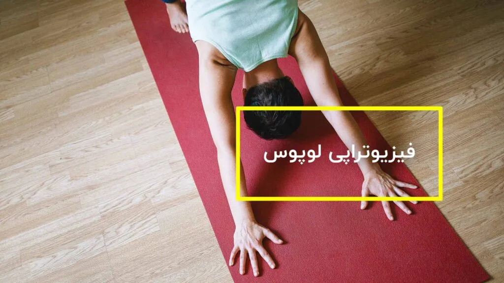 فیزیوتراپی لوپوس