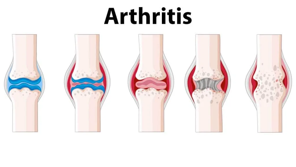 انواع آرتروز