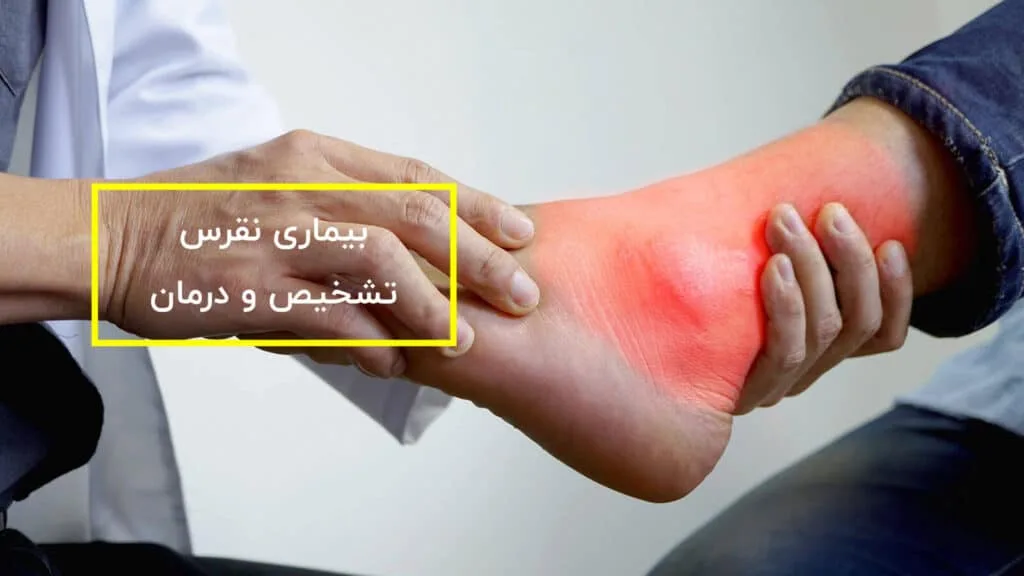 بیماری نقرس، تشخیص، درمان و فیزیوتراپی نقرس