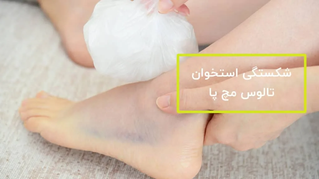 شکستگی استخوان تالوس مچ پا