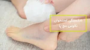 شکستگی استخوان تالوس مچ پا