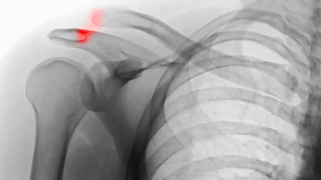 علائم و نشانه های جداشدگی شانه