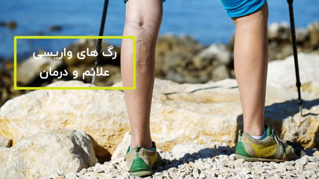 رگ های واریسی چه هستند؟ علائم و درمان