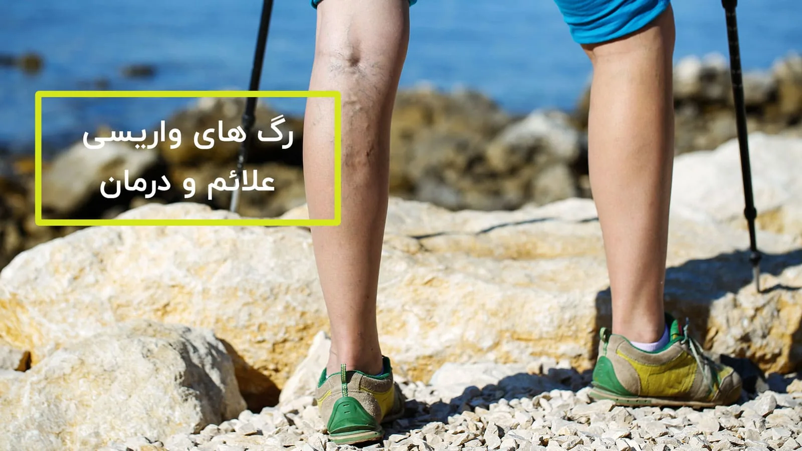 رگ های واریسی چه هستند؟ علائم و درمان