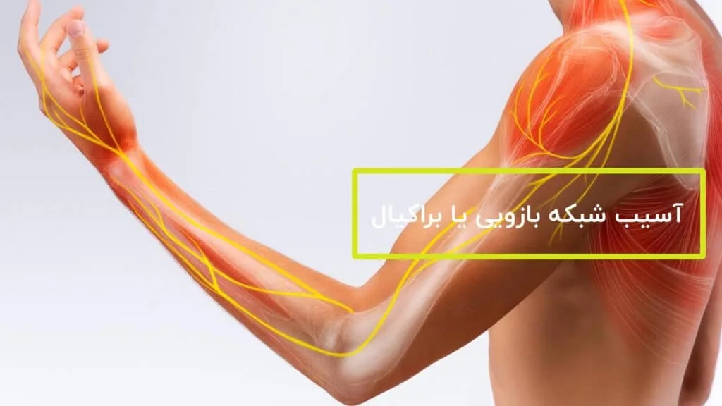 آسیب شبکه بازویی یا براکیال