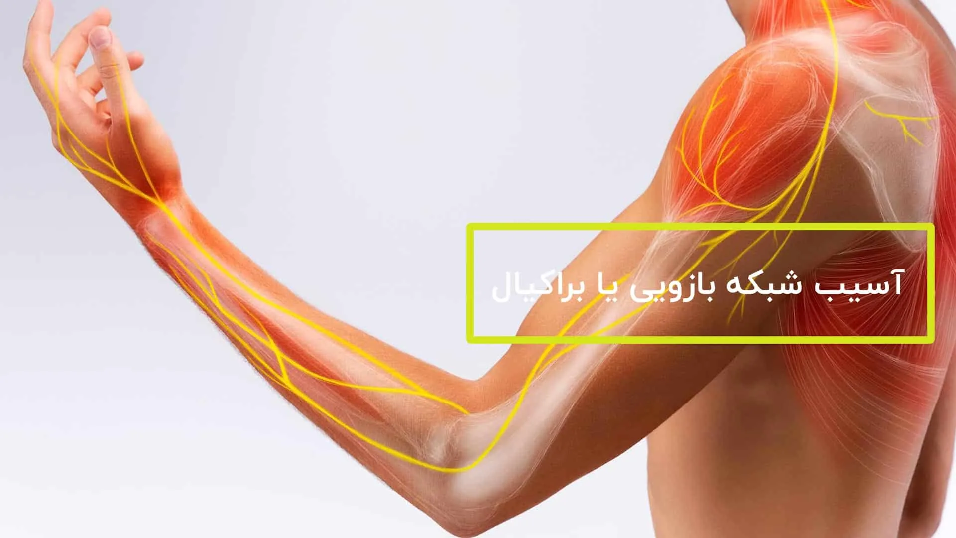 آسیب شبکه بازویی یا براکیال