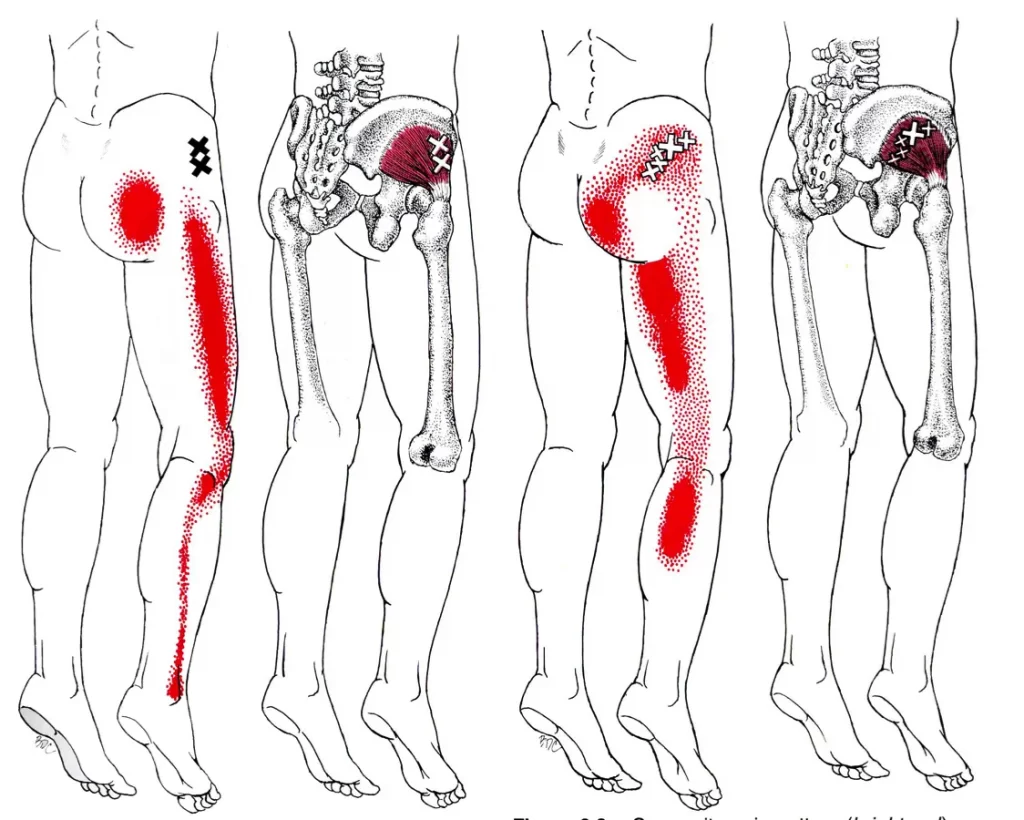 ناحیه درد سیاتیک