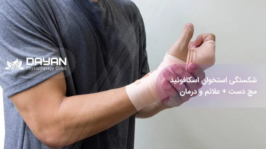 فیزیوتراپی شکستگی استخوان اسکافوئید مچ دست