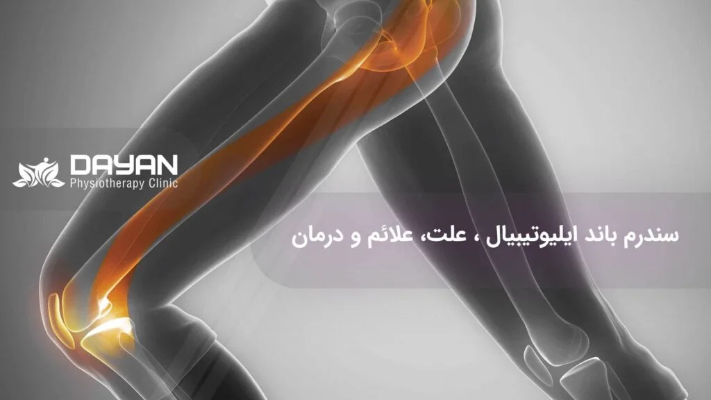 سندرم باند ایلیوتیبیال