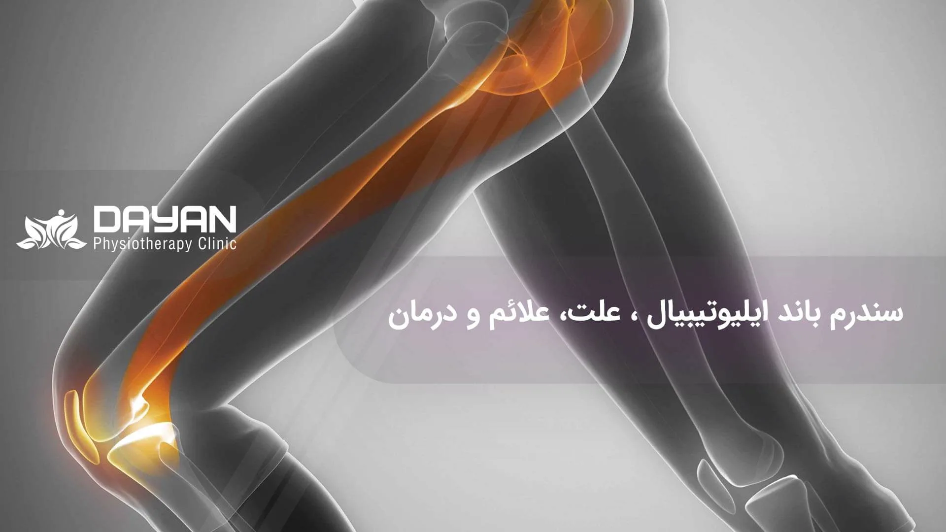 سندرم باند ایلیوتیبیال