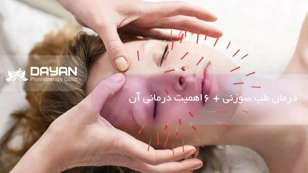 درمان طب سوزنی