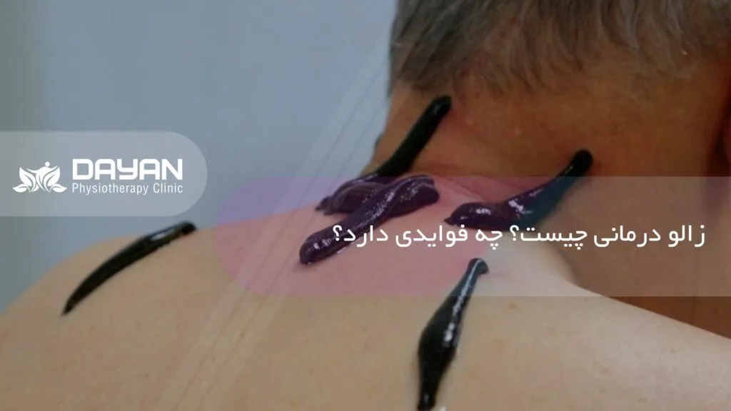 زالو درمانی چیست