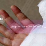 علائم شکستگی انگشت شست دست + درمان