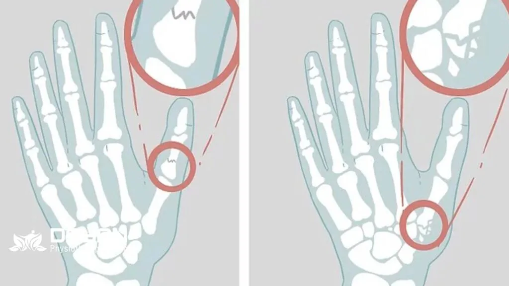 علائم شکستگی انگشت شست دست