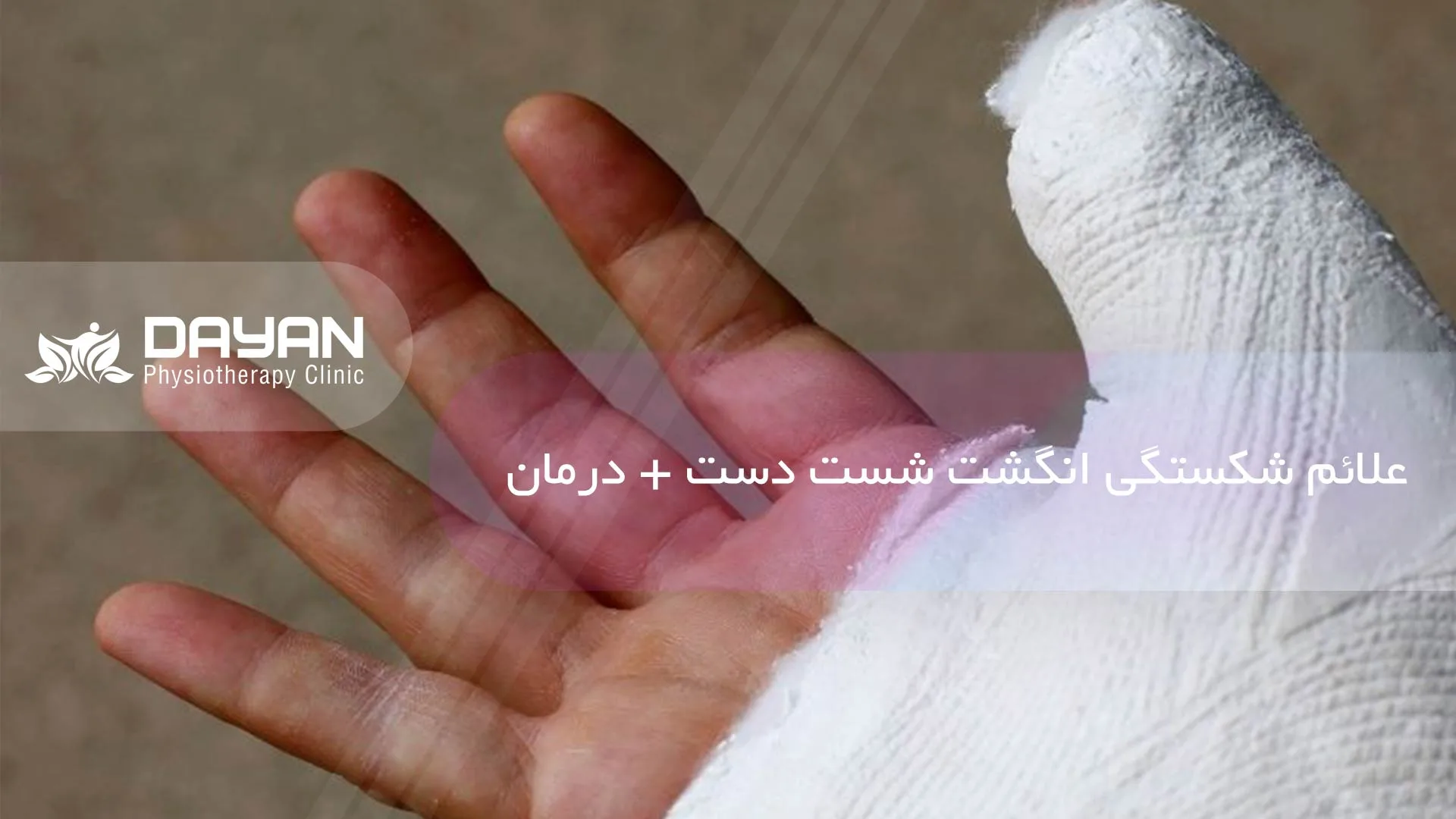 علائم شکستگی انگشت شست دست