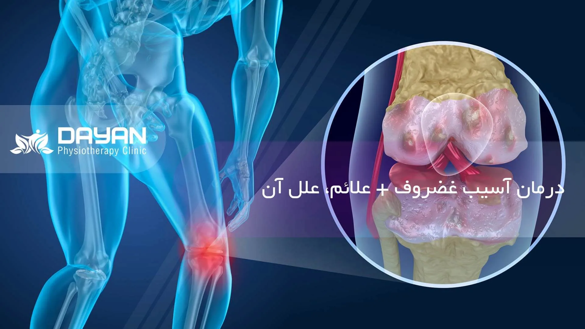 درمان آسیب غضروف