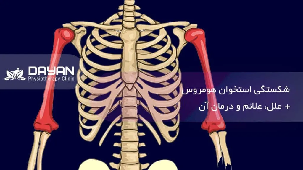 شکستگی استخوان هومرس
