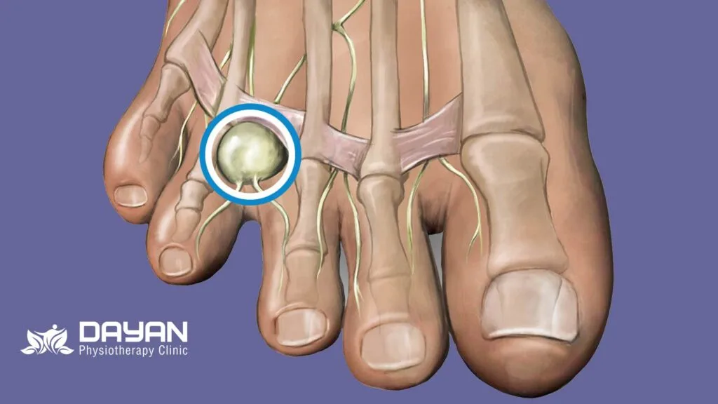 نوروم مورتون پا