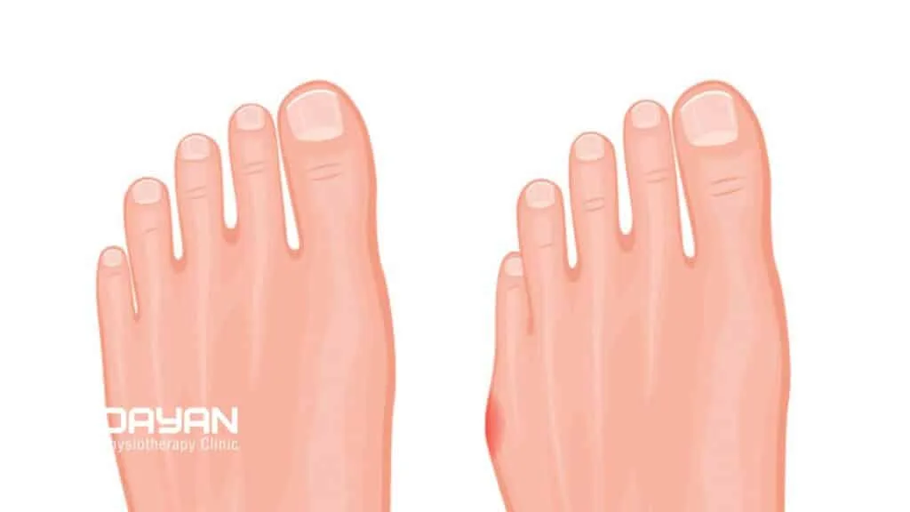 بونیون پا چیست