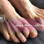 انگشت چکشی پا + دلایل، نشانه‌ها و درمان