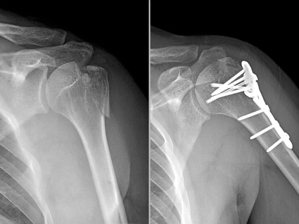 در چه صورتی شکستگی استخوان بازو به جراحی نیاز دارد