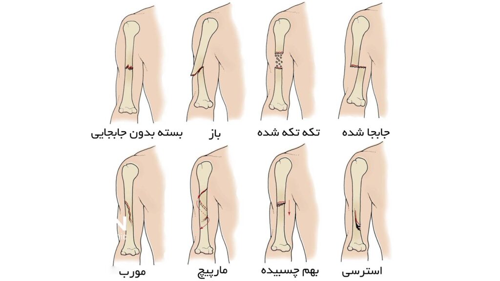 انواع شکستگی استخوان بازو