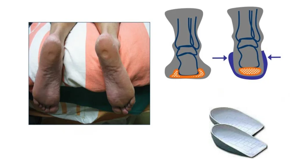 عوارض عدم درمان سندرم پد چربی پاشنه پا