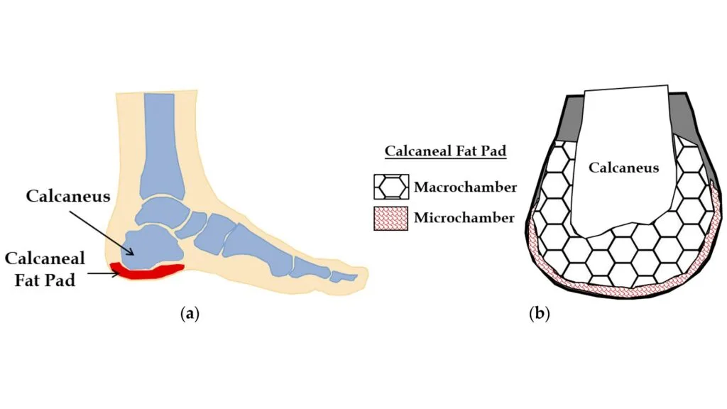 سندرم پد چربی پاشنه پا چیست؟