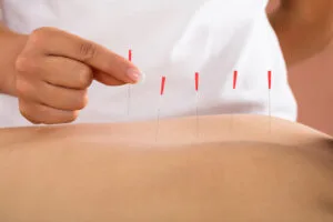 سوزن خشک برای دیسک کمر