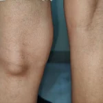 فیزیوتراپی کیست بیکر: درمان قطعی ورم و درد پشت زانو بدون جراحی