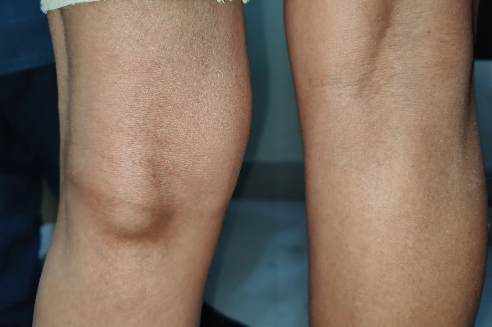 فیزیوتراپی کیست بیکر