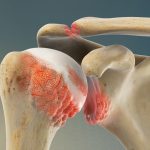 درمان آرتروز شانه